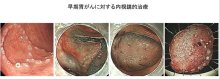 進む胃カメラ治療　死亡数３位に低下　胃がん（２）　千葉県がんセンター内視鏡科医長　北川善康　【９月はがん征圧月間　ちば　がんにうち克つ】（２）