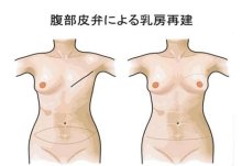 失った乳房取り戻す　専門医の診察受け検討を　乳がん（３）　千葉県がんセンター　形成外科主任医長　徳元秀樹　【ちば　がんにうち克つ】（１３）
