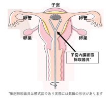 閉経後の出血に注意　「早期」で低侵襲手術も　子宮体がんの特徴　千葉県がんセンター婦人科医員　村岡純輔　【９月はがん征圧月間　ちばがんにうち克つ】（２）