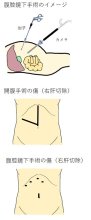 技術進歩で傷小さく　症例次第で開腹手術も　低侵襲手術　千葉県がんセンター肝胆膵外科医長　石毛文隆　【９月はがん征圧月間　ちばがんにうち克つ】（８）